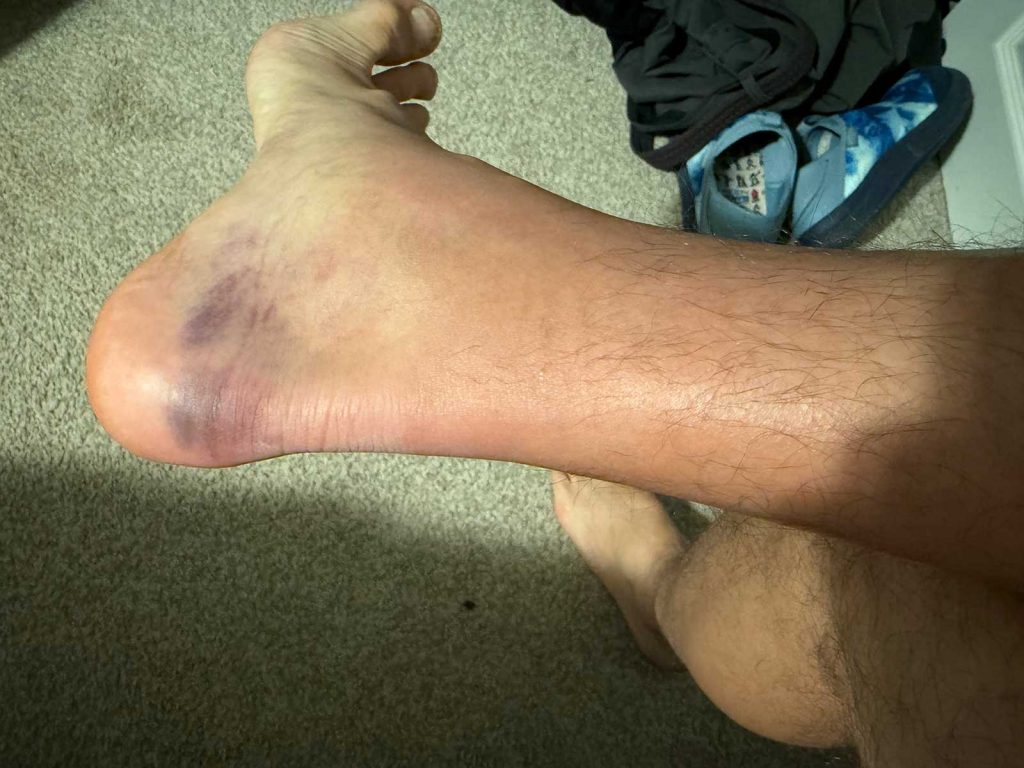 Ruptured Achilles Tendon 4 days after injury from Ruptured Achilles Tendon