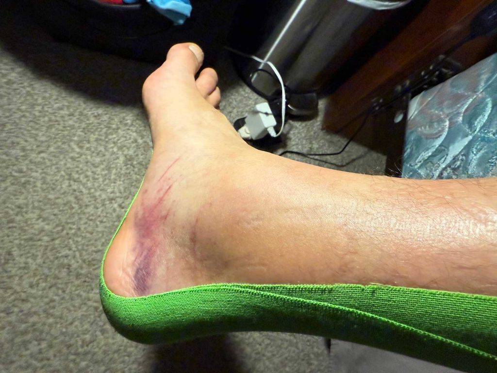 Ruptured Achilles Tendon 1 week after injury