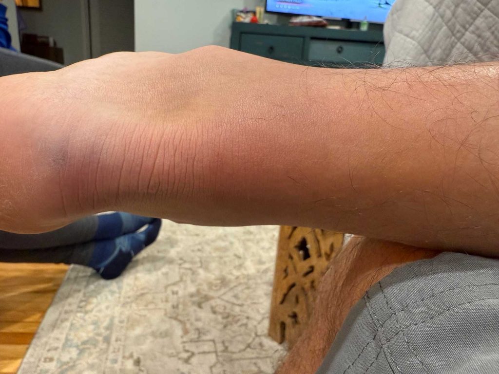 Ruptured Achilles Tendon 1 day after injury from Ruptured Achilles Tendon